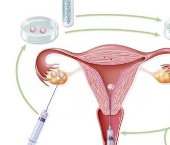 2026北京做完试管婴儿全部费用大概要多少钱？